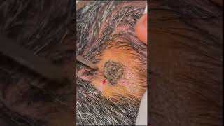 Seborrheic Keratosis Removal by Electrocautery [upl. by Ainosal]