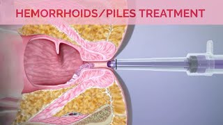 Hemorrhoids Removal Surgery I Hemorrhoid Treatment with Laser Surgery amp Rubber Band Ligation [upl. by Arvie755]