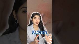 How I Cured My Urticaria Chronic Hives  My Story [upl. by Akedijn816]