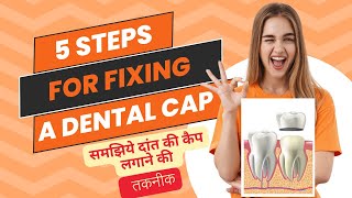 दांतो पर कैप लगाने की तकनीक DENTAL CAP LAGANE KI TAKNEEK Tooth cap fixing procedure in steps [upl. by Shirl329]