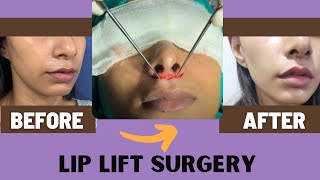 Is Upper Lip Lift Surgery best treatment for your LIPS  Lip Lift Surgery in India  The Aesculpir [upl. by Ari]