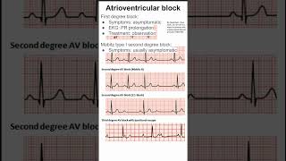 Atrioventricular block [upl. by Gib]