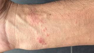 Poison Ivy Treatment with Methylprednisolone [upl. by Araet]