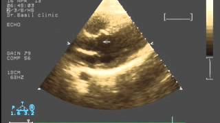 subvalvular aortic stenosis [upl. by Ahsiemat]