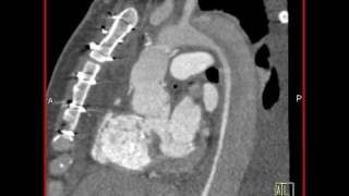 Cardiac Aortic dissection with compression of the true lumen by false lumen 4 of 4 [upl. by Ailadgim719]