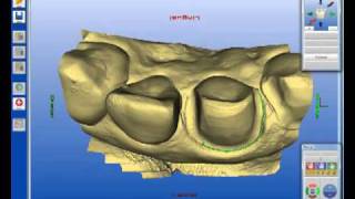 Cerec Veneers by Daniel Vasquez DDS [upl. by Vitek]