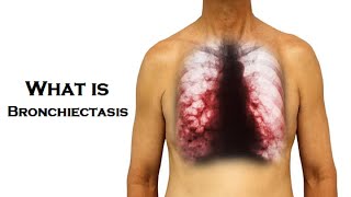 What is Bronchiectasis  Dr Technology [upl. by Aliek260]