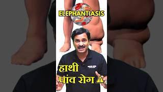 Elephantiasis Filariasis  हाथी पांव रोग 😰 disease neetpreparation neetexam [upl. by Gnep763]