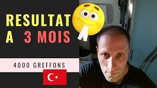 Greffe de cheveux FUE en Turquie Vidéo 11  Résultat à 3 mois  4000 Greffons [upl. by Enelcaj83]