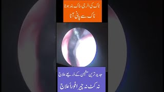 Cryotherapy Nasal Allergy Naak Ka band hona  Pani Ana  Dr Sarfraz Latif [upl. by Nysila705]