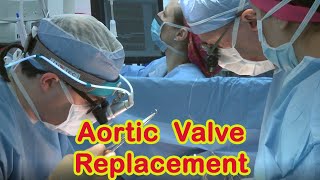 Aortic Valve Replacement Surgery [upl. by Okajima]