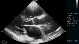 FLAIL MITRAL LEAFLET  ECHOCARDIOGRAPHY SERIES BY DRANKURKCHAUDHARI [upl. by Ahseila]