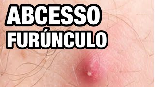 FURÚNCULO COMO TRATAR ABSCESSO TUMOR DE PUS [upl. by Enileuqkcaj]