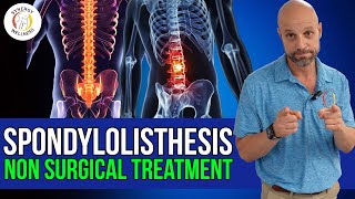 Spondylolisthesis Non Surgical Chiropractic Treatment [upl. by Aiset498]