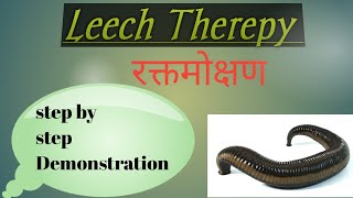 LEECH THERAPY जलौका रक्तमोक्षण क्या होता है इस से [upl. by Ardnahsal612]