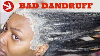 How To Permanently Cure Itchy Scalp amp Rid of Dandruff [upl. by Akemor]