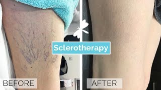 Sclerotherapy Leg Vein Treatment  The Laser and Skin Clinic [upl. by Nylac785]