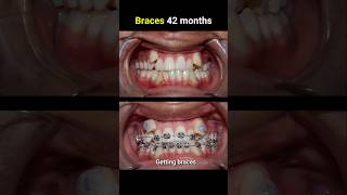 42 months for this braces casr braces orthodontist bracesoff bracesbeforeandafter [upl. by Haya]