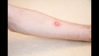 Is it ringworm Signs and symptoms [upl. by Eustazio805]