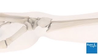 How a wrist fracture is treated  Bupa Health [upl. by Tamas883]