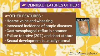 Ectodermal Dysplasia Symptoms Types Causes Diagnosis Treatment amp Life Expectancy [upl. by Arakahs]