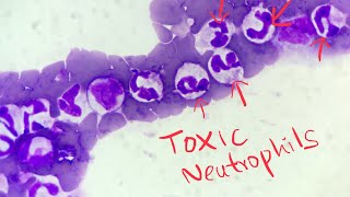 Neutrophilia left shift  grading and prognosis [upl. by Novelia602]