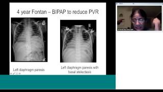 Pedicardio classes on Post op management of GlennFontan by Dr Parvati Iyer [upl. by Stovall653]