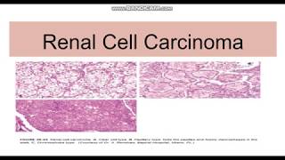 Renal cell carcinoma TypesGeneticsMorphology [upl. by Theall]