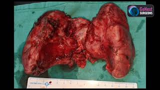 Thyroidectomy Huge Thyroid with compressive symptoms [upl. by Sinnaoi]