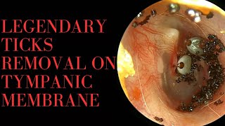 LEGENDARY Ticks Removal On Tympanic Membrane 🤯🤯🤯 [upl. by Eirelav]