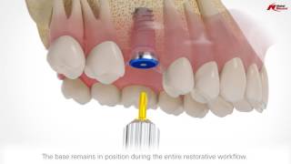 On1 restorative concept  Nobel Biocare [upl. by Lek]