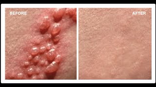 How To Cure Herpes  Cures for Herpes  Herpes Cures [upl. by Charleton408]