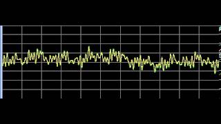 Hemorrhoids  Rife Frequencies [upl. by Atteloiv]