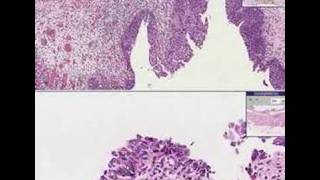 Histopathology Bladder Transitional Carcinomainsitu [upl. by Atinob]