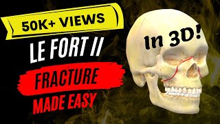 ORAL SURGERY  Le Fort II Fracture in 3D [upl. by Ahsieat252]