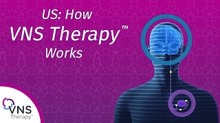 Why do patients choose VNS Therapy epilepsy treatment [upl. by Gati]