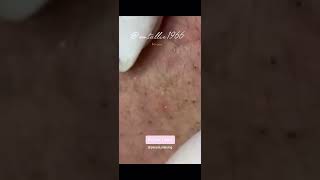 Blackheads Removal  Acne Treatment and Very Satisfying Satisfying Pimple pop blackheads [upl. by Ardehs]