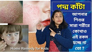 How do you treat baby common skin problem  Baby skin care  পদ্ম কাঁটা কি এর ঘরোয়া সমাধান কি [upl. by Eon]