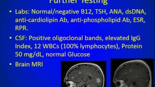 Transverse myelitis mimic MS [upl. by Nhojleahcim]