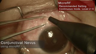 Conjunctival Nevus Treatment using MicroRF [upl. by Trinee]