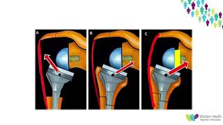 OrthoFracs Reverse Total Shoulder Replacement Complications by Dr James Drummond [upl. by Oflodor]