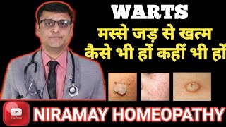 मस्से को जड़ से हटाने के उपाय  Home remedies for warts 100 effective [upl. by Ahcsas]