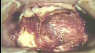 Removal of Large Ameloblastoma of Mandible [upl. by Eillim450]