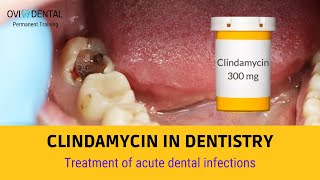 CLINDAMYCIN IN DENTISTRY  Treatment of acute dental infections [upl. by Bashemath]