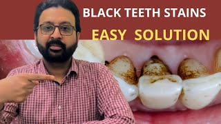 My Teeth Have BLACK STAINS  Teeth Black Stain Removal by Doctor and at Home [upl. by Nosmoht]