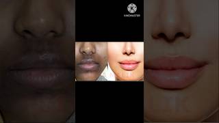 How to remove dark black patches dark spots and pigmentation around mouth [upl. by Boothman471]