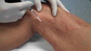 Sclerotherapy  The Vein Centre  Dr Richard Murbach  Treatment for Spider Veins [upl. by Pamela]