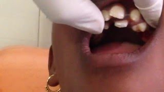 Removal of milk tooth [upl. by Beatrix]