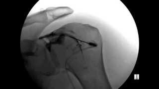 ORTHOMED Shoulder Injection under Fluoroscopic [upl. by Corley]