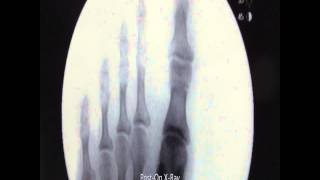 Bilateral Akin Osteotomy Hammertoe Correction With XRays [upl. by Joung]